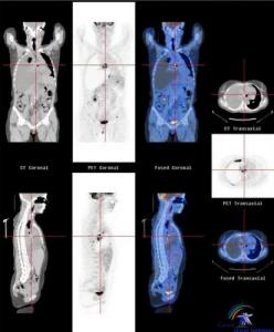 TEP PET SCAN